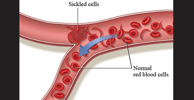 बीमारी खत्म करने को लिखा जाएगा सिकल सेल का इतिहास